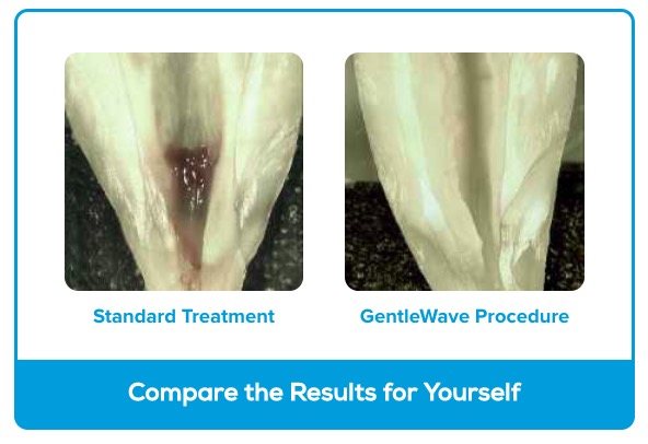 Gentlewave comparison