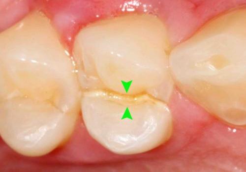 Cracked_tooth
