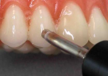 Electric_pulp_testing_tooth