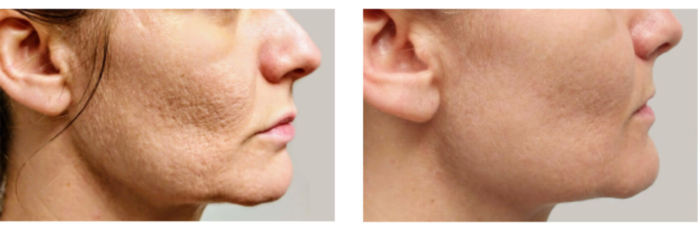 scarlet srf before and after